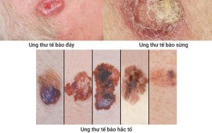 Ung thư da là gì? Nguyên nhân, triệu chứng, chẩn đoán và cách điều trị dứt điểm 
