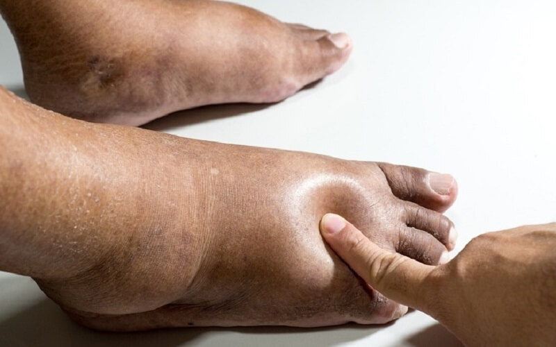 Phù chân ở người già gây ra nhiều biến chứng