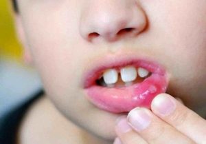 Bị nhiệt miệng làm thế nào?