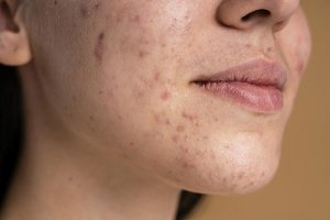 8 Bí Quyết Điều Trị Vết Thâm Da Hiệu Quả và An Toàn